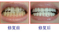 牙齿美白案例